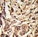 GALT Antibody - Formalin-fixed and paraffin-embedded human breast carcinoma reacted with GALT Antibody , which was peroxidase-conjugated to the secondary antibody, followed by DAB staining. This data demonstrates the use of this antibody for immunohistochemistry; clinical relevance has not been evaluated.