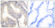 Gastrin Antibody - Immunohistochemistry analysis of paraffin-embedded human colon carcinoma tissue, using Gastrin Antibody. The picture on the right is blocked with the synthesized peptide.