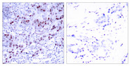 GATA1 Antibody - Immunohistochemistry analysis of paraffin-embedded human breast carcinoma tissue, using GATA1 Antibody. The picture on the right is blocked with the synthesized peptide.