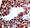 GATA3 Antibody - IHC of GATA-3 on FFPE Breast Carcinoma Tissue.