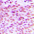 GATA4 Antibody - Immunohistochemical analysis of GATA4 staining in human breast cancer formalin fixed paraffin embedded tissue section. The section was pre-treated using heat mediated antigen retrieval with sodium citrate buffer (pH 6.0). The section was then incubated with the antibody at room temperature and detected using an HRP conjugated compact polymer system. DAB was used as the chromogen. The section was then counterstained with hematoxylin and mounted with DPX.