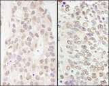 GATAD2B Antibody - Detection of Human and Mouse p66beta/GATAD2B by Immunohistochemistry. Sample: FFPE section of human breast carcinoma (left) and mouse teratoma (right). Antibody: Affinity purified rabbit anti-p66beta/GATAD2B used at a dilution of 1:200 (1 ug/ml). Detection: DAB.