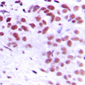 GAX / MEOX2 Antibody - Immunohistochemical analysis of MEOX2 staining in human breast cancer formalin fixed paraffin embedded tissue section. The section was pre-treated using heat mediated antigen retrieval with sodium citrate buffer (pH 6.0). The section was then incubated with the antibody at room temperature and detected using an HRP conjugated compact polymer system. DAB was used as the chromogen. The section was then counterstained with hematoxylin and mounted with DPX.