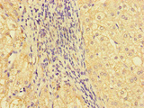 GBA2 Antibody - Immunohistochemistry of paraffin-embedded human liver cancer at dilution of 1:100