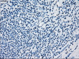 GBP2 Antibody - Immunohistochemical staining of paraffin-embedded Carcinoma of thyroid tissue using anti-GBP2 mouse monoclonal antibody. (Dilution 1:50).