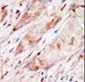 GCK / Glucokinase Antibody - Formalin-fixed and paraffin-embedded human cancer tissue reacted with the primary antibody, which was peroxidase-conjugated to the secondary antibody, followed by AEC staining. This data demonstrates the use of this antibody for immunohistochemistry; clinical relevance has not been evaluated. BC = breast carcinoma; HC = hepatocarcinoma.