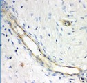 GCLC Antibody - GCLC antibody IHC-paraffin: Human Mammary Cancer Tissue.