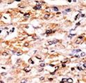 GCN2 Antibody - Formalin-fixed and paraffin-embedded human cancer tissue reacted with the primary antibody, which was peroxidase-conjugated to the secondary antibody, followed by AEC staining. This data demonstrates the use of this antibody for immunohistochemistry; clinical relevance has not been evaluated. BC = breast carcinoma; HC = hepatocarcinoma.