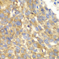 GCN2 Antibody - Immunohistochemistry of paraffin-embedded human esophageal cancer tissue.