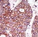 GCNT1 / C2GNT Antibody - Formalin-fixed and paraffin-embedded human cancer tissue reacted with the primary antibody, which was peroxidase-conjugated to the secondary antibody, followed by DAB staining. This data demonstrates the use of this antibody for immunohistochemistry; clinical relevance has not been evaluated. BC = breast carcinoma; HC = hepatocarcinoma.