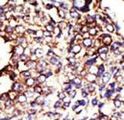 GCNT1 / C2GNT Antibody - Formalin-fixed and paraffin-embedded human cancer tissue reacted with the primary antibody, which was peroxidase-conjugated to the secondary antibody, followed by DAB staining. This data demonstrates the use of this antibody for immunohistochemistry; clinical relevance has not been evaluated. BC = breast carcinoma; HC = hepatocarcinoma.