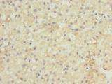 GDF2 / BMP9 Antibody - Immunohistochemistry of paraffin-embedded human liver cancer using antibody at dilution of 1:100.