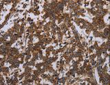 GDF2 / BMP9 Antibody - Immunohistochemistry of paraffin-embedded Human liver cancer using GDF2 Polyclonal Antibody at dilution of 1:40.