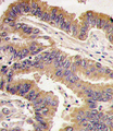 GDF5 / GDF-5 Antibody - Formalin-fixed and paraffin-embedded human lung carcinoma tissue reacted with GDF5 antibody , which was peroxidase-conjugated to the secondary antibody, followed by DAB staining. This data demonstrates the use of this antibody for immunohistochemistry; clinical relevance has not been evaluated.