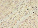 GDPD2 / GDE3 Antibody - Immunohistochemistry of paraffin-embedded human liver cancer using antibody at dilution of 1:100.