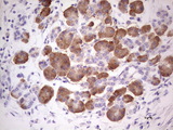 GEMIN8 Antibody - IHC of paraffin-embedded Carcinoma of Human pancreas tissue using anti-GEMIN8 mouse monoclonal antibody. (heat-induced epitope retrieval by 1 mM EDTA in 10mM Tris, pH8.5, 120°C for 3min).