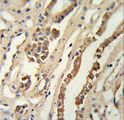 Geminin Antibody - GMNN Antibody (Center Y111) IHC of formalin-fixed and paraffin-embedded lung carcinoma tissue followed by peroxidase-conjugated secondary antibody and DAB staining. This data demonstrates the use of the GMNN Antibody (Center Y111) for immunohistochemistry.