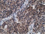 Gephyrin Antibody - IHC of paraffin-embedded Adenocarcinoma of Human ovary tissue using anti-GPHN mouse monoclonal antibody.