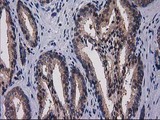 Gephyrin Antibody - IHC of paraffin-embedded Carcinoma of Human prostate tissue using anti-GPHN mouse monoclonal antibody.