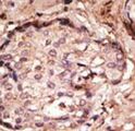 GFAP Antibody - Formalin-fixed and paraffin-embedded human cancer tissue reacted with the primary antibody, which was peroxidase-conjugated to the secondary antibody, followed by DAB staining. This data demonstrates the use of this antibody for immunohistochemistry; clinical relevance has not been evaluated. BC = breast carcinoma; HC = hepatocarcinoma.