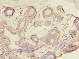 GFOD2 Antibody - Immunohistochemistry of paraffin-embedded human breast cancer using antibody at 1:100 dilution.  This image was taken for the unconjugated form of this product. Other forms have not been tested.