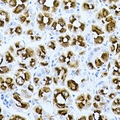 GHRH Antibody - Immunohistochemical analysis of GHRH staining in human gastric cancer formalin fixed paraffin embedded tissue section. The section was pre-treated using heat mediated antigen retrieval with sodium citrate buffer (pH 6.0). The section was then incubated with the antibody at room temperature and detected using an HRP conjugated compact polymer system. DAB was used as the chromogen. The section was then counterstained with hematoxylin and mounted with DPX.
