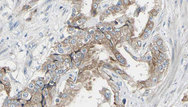 GIT1 Antibody - 1:100 staining human prostate tissue by IHC-P. The sample was formaldehyde fixed and a heat mediated antigen retrieval step in citrate buffer was performed. The sample was then blocked and incubated with the antibody for 1.5 hours at 22°C. An HRP conjugated goat anti-rabbit antibody was used as the secondary.