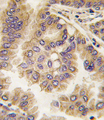 GJA5 / CX40 / Connexin 40 Antibody - Formalin-fixed and paraffin-embedded human lung carcinoma tissue reacted with GJA5 antibody , which was peroxidase-conjugated to the secondary antibody, followed by DAB staining. This data demonstrates the use of this antibody for immunohistochemistry; clinical relevance has not been evaluated.