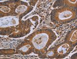 GJB4 / CX30.3 / Connexin 30.3 Antibody - Immunohistochemistry of paraffin-embedded Human colon cancer using GJB4 Polyclonal Antibody at dilution of 1:40.