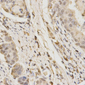 GLB1 / Beta-Galactosidase Antibody - Immunohistochemistry of paraffin-embedded human stomach cancer tissue.