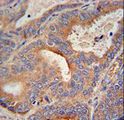 GLB1L2 Antibody - GLB1L2 antibody immunohistochemistry of formalin-fixed and paraffin-embedded human prostate carcinoma followed by peroxidase-conjugated secondary antibody and DAB staining.