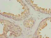 GLB1L2 Antibody - Immunohistochemistry of paraffin-embedded human prostate cancer using antibody at dilution of 1:100.
