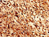 GLE1 Antibody - Immunocytochemistry analysis of human melanoma using GLE1 Antibody at dilution of 1:100