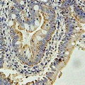 GLNRS / QARS Antibody - Immunohistochemical analysis of GlnRS staining in human colon cancer formalin fixed paraffin embedded tissue section. The section was pre-treated using heat mediated antigen retrieval with sodium citrate buffer (pH 6.0). The section was then incubated with the antibody at room temperature and detected using an HRP conjugated compact polymer system. DAB was used as the chromogen. The section was then counterstained with hematoxylin and mounted with DPX.