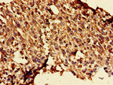 GLRA1/Glycine Receptor Alpha 1 Antibody - Immunohistochemistry of paraffin-embedded human melanoma cancer at dilution of 1:100