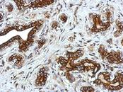 GLRA2 Antibody - IHC of paraffin-embedded Breast ca using Glycine Receptor alpha 2 antibody at 1:750 dilution.