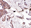GLRX2 / Glutaredoxin 2 Antibody - IHC analysis of Glutaredoxin 2 using anti-Glutaredoxin 2 antibody. Glutaredoxin 2 was detected in paraffin-embedded section of human mammary cancer tissue. Heat mediated antigen retrieval was performed in citrate buffer (pH6, epitope retrieval solution) for 20 mins. The tissue section was blocked with 10% goat serum. The tissue section was then incubated with 1µg/ml rabbit anti-Glutaredoxin 2 Antibody overnight at 4°C. Biotinylated goat anti-rabbit IgG was used as secondary antibody and incubated for 30 minutes at 37°C. The tissue section was developed using Strepavidin-Biotin-Complex (SABC) with DAB as the chromogen.