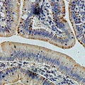GLUD1/Glutamate Dehydrogenase Antibody - Immunohistochemical analysis of GLUD1 staining in human colon cancer formalin fixed paraffin embedded tissue section. The section was pre-treated using heat mediated antigen retrieval with sodium citrate buffer (pH 6.0). The section was then incubated with the antibody at room temperature and detected using an HRP conjugated compact polymer system. DAB was used as the chromogen. The section was then counterstained with hematoxylin and mounted with DPX.