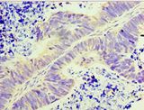 GLYATL1 Antibody - Immunohistochemistry of paraffin-embedded human ovarian cancer using antibody at 1:100 dilution.