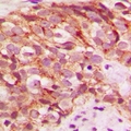 GLYCTK / Glycerate Kinase Antibody - Immunohistochemical analysis of Glycerate Kinase staining in human breast cancer formalin fixed paraffin embedded tissue section. The section was pre-treated using heat mediated antigen retrieval with sodium citrate buffer (pH 6.0). The section was then incubated with the antibody at room temperature and detected with HRP and DAB as chromogen. The section was then counterstained with hematoxylin and mounted with DPX.