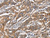 GNA13 Antibody - Immunohistochemistry of paraffin-embedded Human gastric cancer using GNA13 Polyclonal Antibody at dilution of 1:30.