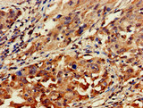 GNAT1 Antibody - Immunohistochemistry of paraffin-embedded human lung cancer at dilution of 1:100