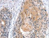 GNAT3 / Gustducin Antibody - Immunohistochemistry of paraffin-embedded Human esophagus cancer using GNAT3 Polyclonal Antibody at dilution of 1:35.