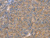 GNB1 Antibody - Immunohistochemistry of paraffin-embedded Human liver cancer using GNB1 Polyclonal Antibody at dilution of 1:20.
