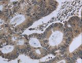 GNG2 Antibody - Immunohistochemistry of paraffin-embedded Human colon cancer using GNG2 Polyclonal Antibody at dilution of 1:60.