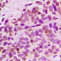 GNL3L Antibody - Immunohistochemical analysis of GNL3L staining in human breast cancer formalin fixed paraffin embedded tissue section. The section was pre-treated using heat mediated antigen retrieval with sodium citrate buffer (pH 6.0). The section was then incubated with the antibody at room temperature and detected using an HRP conjugated compact polymer system. DAB was used as the chromogen. The section was then counterstained with hematoxylin and mounted with DPX.