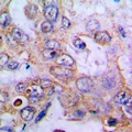 GNRH2 Antibody - IHC-P: FFPE human lung carcinoma