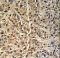 GNS Antibody - GNS Antibody (Center S298) IHC of formalin-fixed and paraffin-embedded human hepatocarcinoma followed by peroxidase-conjugated secondary antibody and DAB staining.