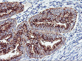 GOLM1 / GP73 / GOLPH2 Antibody - IHC of paraffin-embedded Adenocarcinoma of Human endometrium tissue using anti-GOLM1 mouse monoclonal antibody.