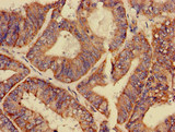 GPAM Antibody - Immunohistochemistry of paraffin-embedded human endometrial cancer at dilution of 1:100